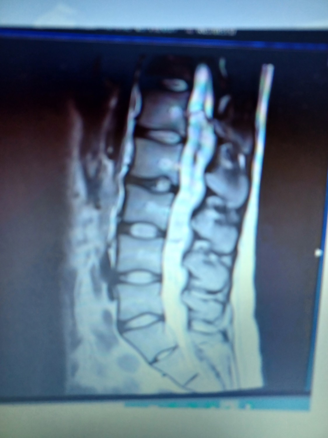 This is the scan of Sam's 8 inch Spinal Tumour - all successfully removed due to the brilliant Spinal Surgeons at Southmead Hospital.  